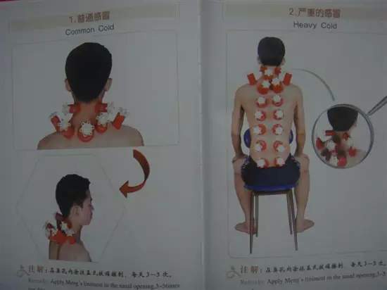 拔罐有哪些穴位图解,最全拔罐穴位疗法图解