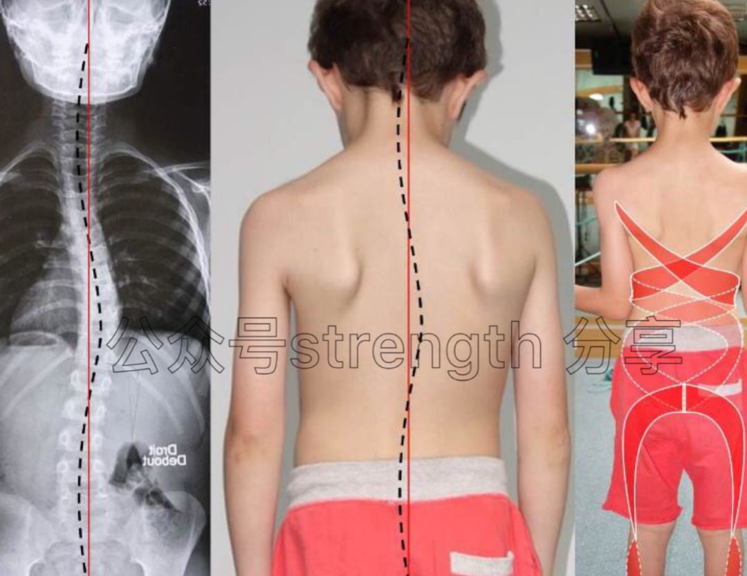 完美的运动模式——肌肉链运动