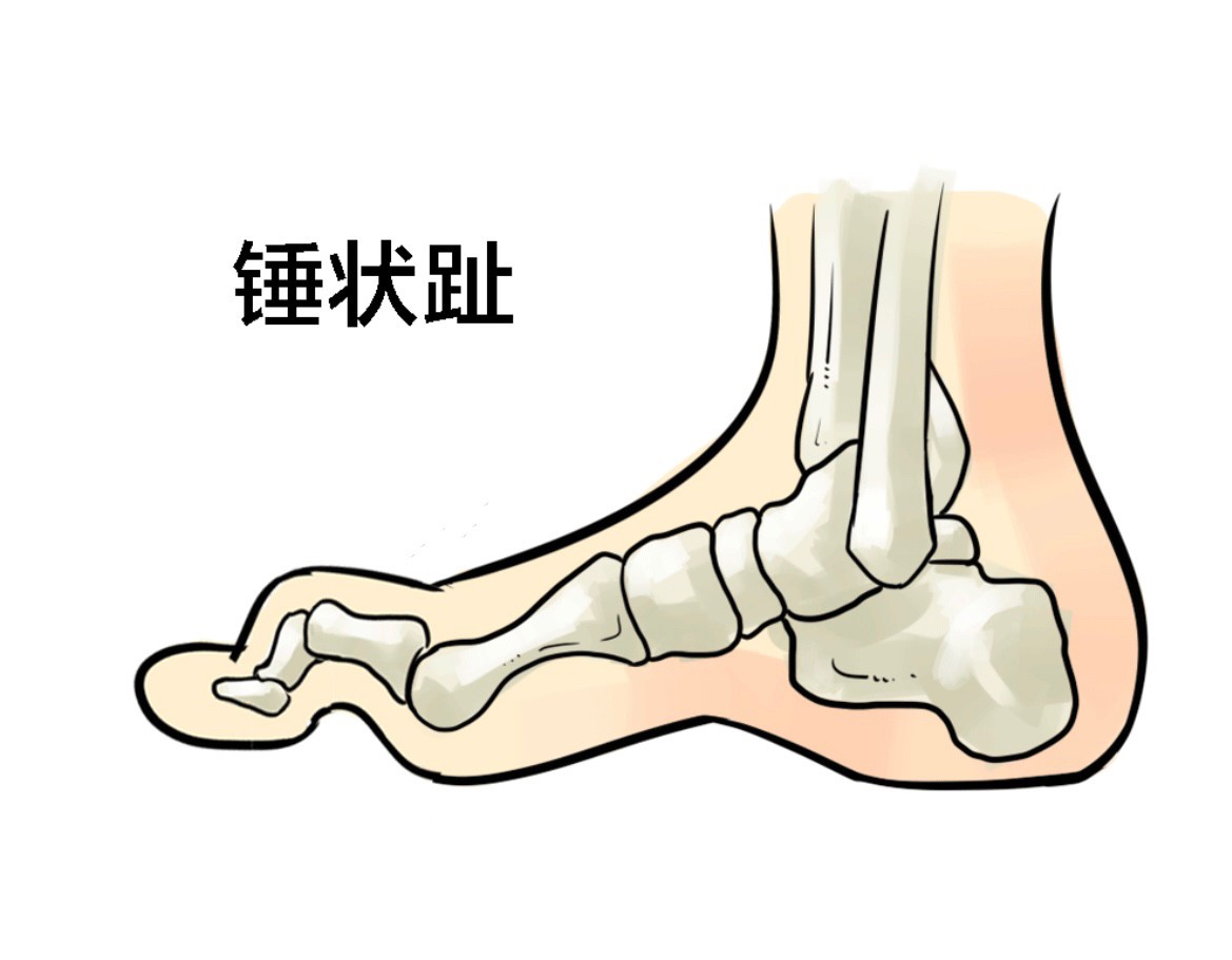 大姐骨折后康复视频,大姐骨折