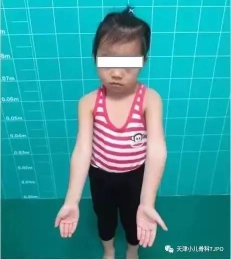 儿童胳膊肘朝外拐怎么办,小孩胳膊肘往外拐为什么会黑