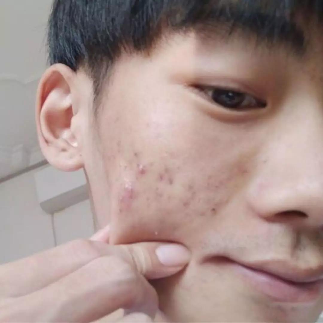 祛痘印的方法怎么可以快速祛痘印,怎样有效快速祛痘祛痘印