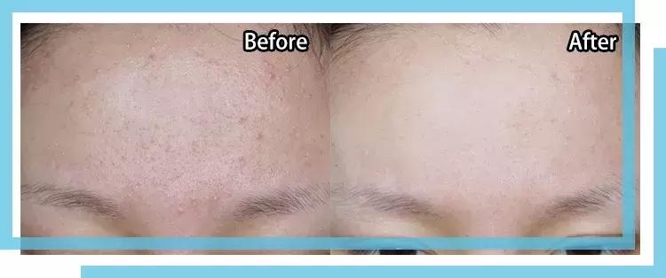 如何有效的祛痘印医美面膜,消炎祛痘的医美面膜