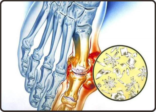 痛风能治好吗痛风的治疗最好方法,痛风发作缓解痛风的最有效的方法