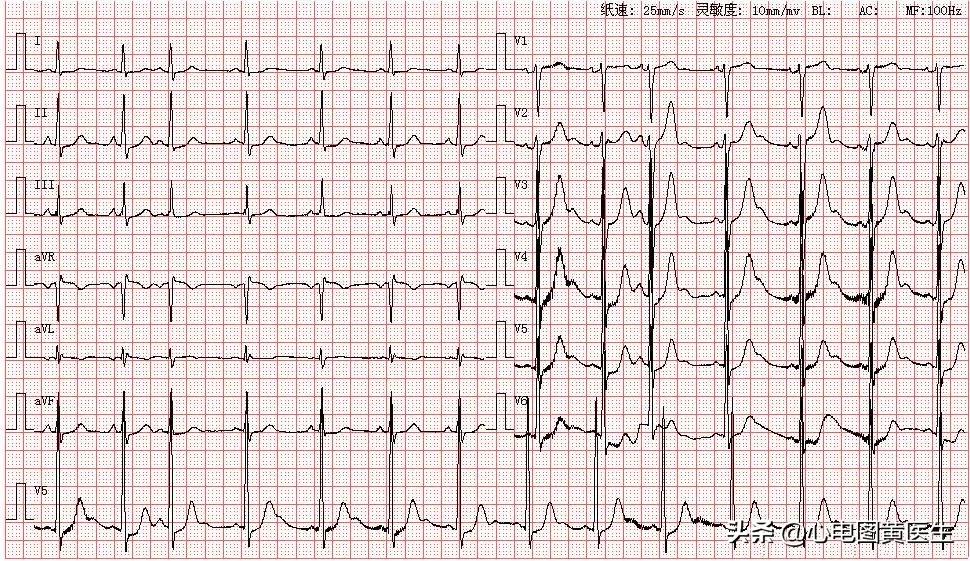 心电图出现qrs电压交替现象,心电图出现u和t波倒置