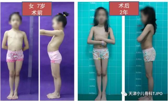 小儿先天性髋内翻名词解释,小孩走路颠足内翻