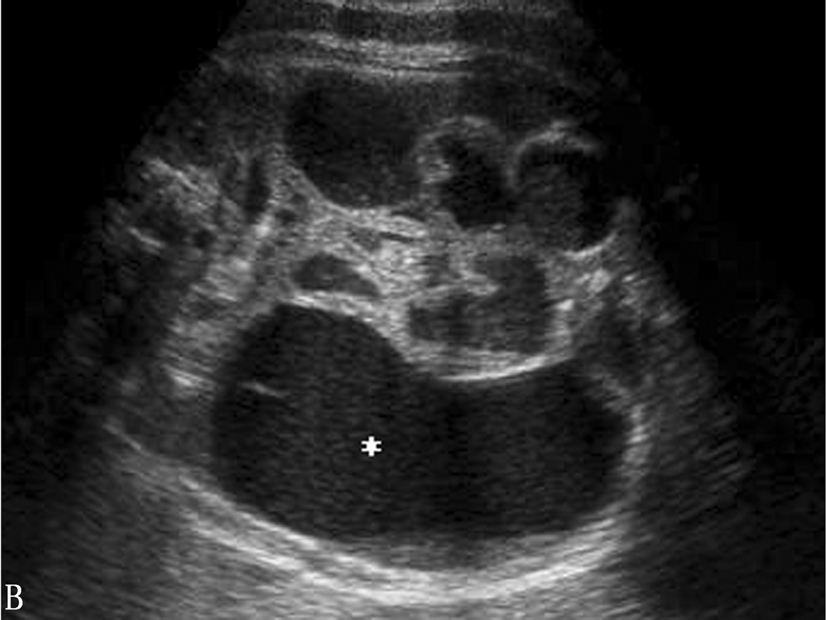 胎儿消化系统畸形,超声能检查出胎儿消化系统畸形吗