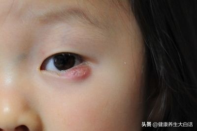 解决麦粒肿,生活小妙招麦粒肿