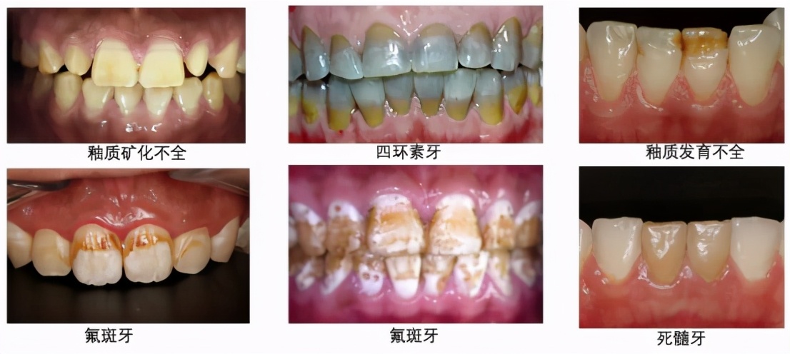 什么方法最适合去黄牙不伤牙齿,一口老黄牙怎么治疗