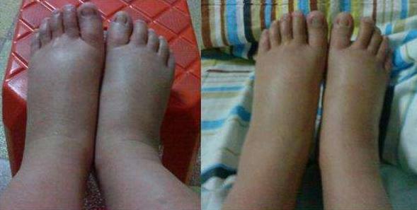 孕期的各种腿脚肿痛，哪些需要就医？