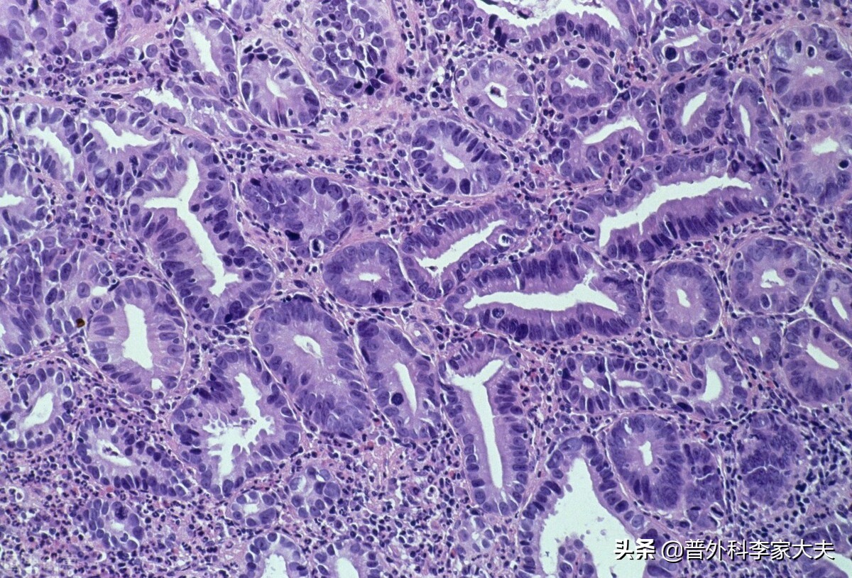 不能切除的晚期胃癌能活多久,胃癌患者可行胃癌根治术