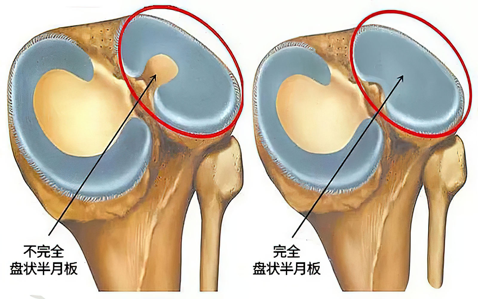 膝关节骨软骨损伤什么原因,膝关节骨关节炎软骨退化康复训练