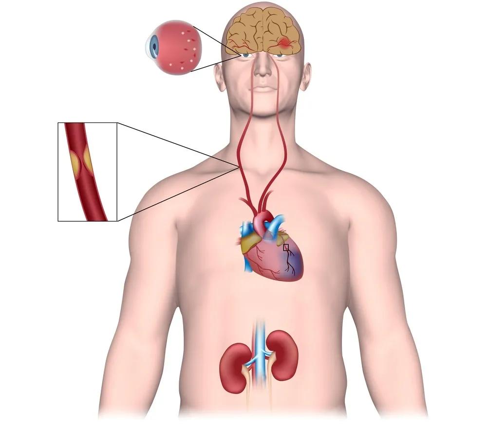 自测血压能查出什么病,血压高如何自测血管