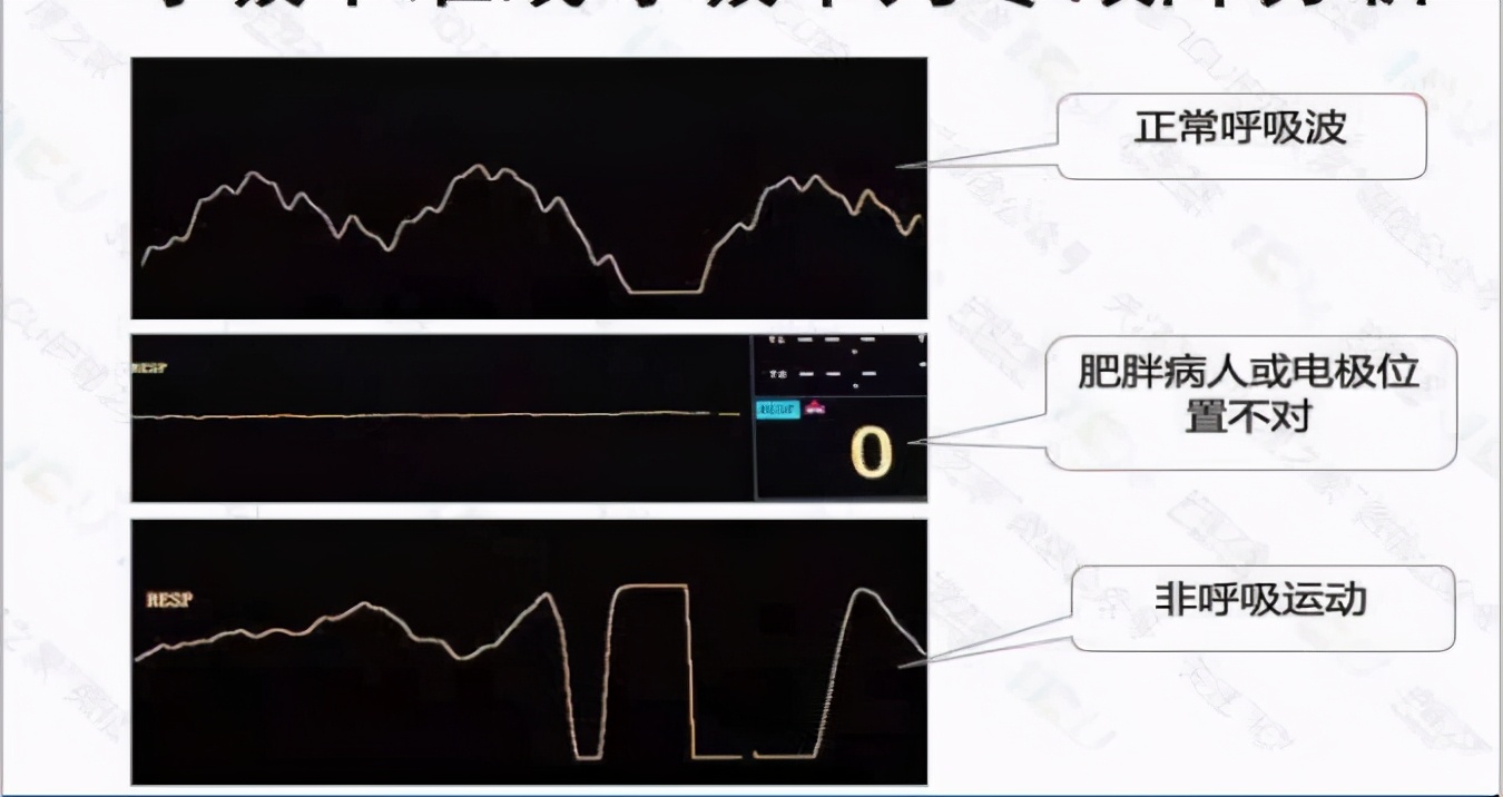 心电监护使用的收费标准,心电监护使用年限