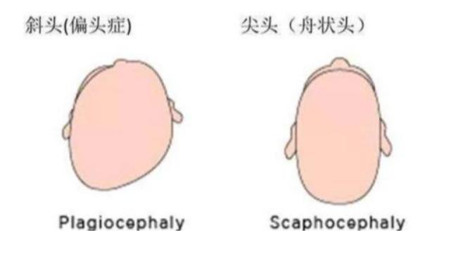 小孩后脑勺很平有什么影响吗,小孩后脑勺尖是否聪明