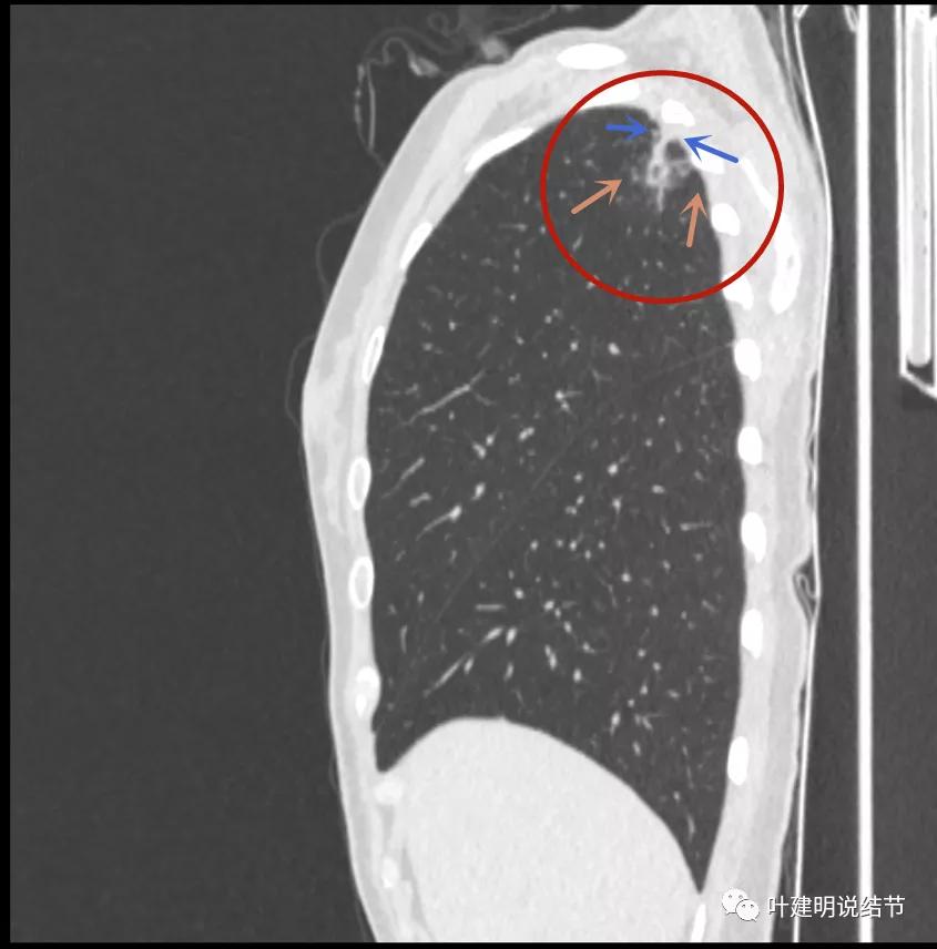 临床诊断孤立性肺结节,空洞型结节一般是什么性质