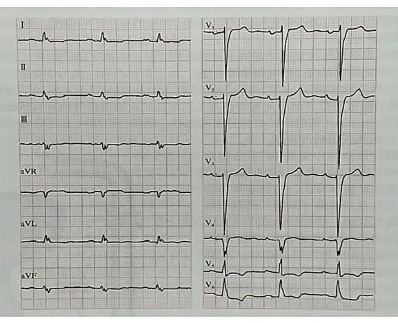 心力衰竭心功能恢复,心力衰竭的病理生理机制动画