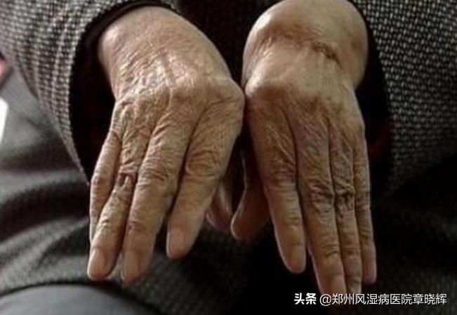 类风湿长期服药方案,治疗类风湿的27种药