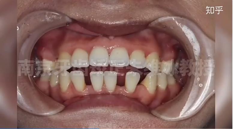 牙齿矫正骨开窗,骨壁比较薄牙齿矫正会骨开窗吗