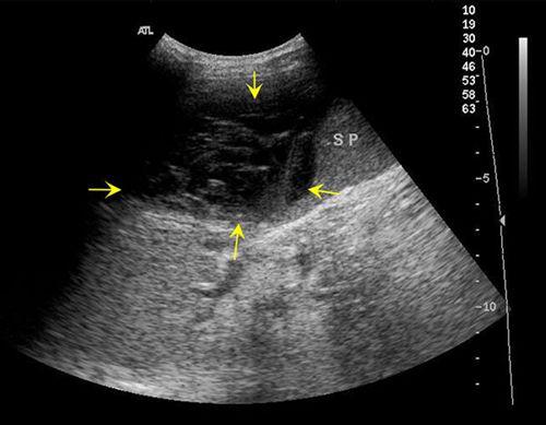 怎么排除脾脏破裂,如何能造成脾脏破裂