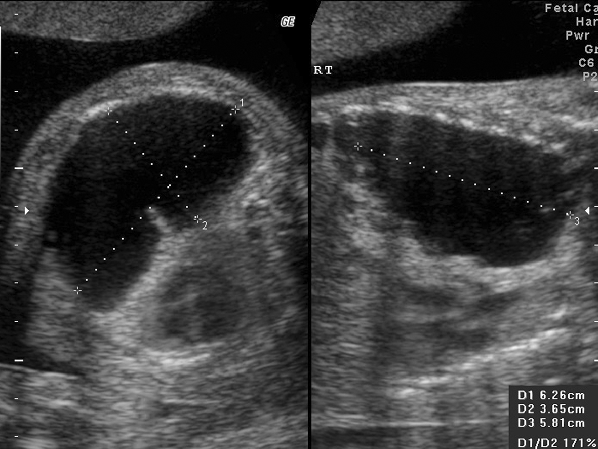 超声检查可以看到胎儿肺部吗,针对性胎儿心脏超声检查