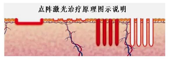 点阵激光祛痘印的副作用和危害,co2点阵激光危害