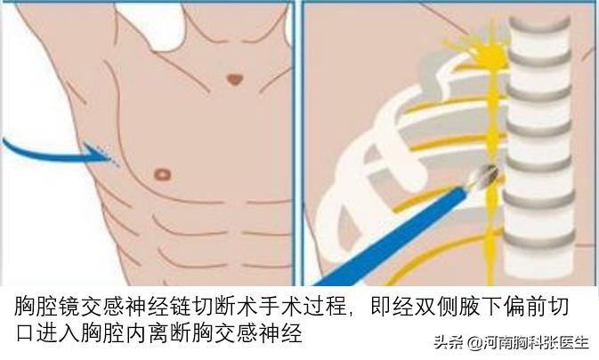 手汗症需要治疗吗,手出很多汗是什么病