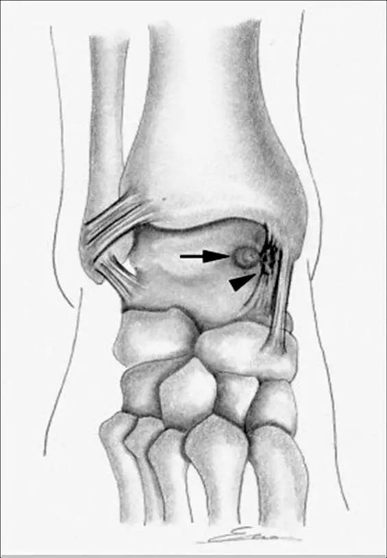 踝关节撞击症问诊,踝关节内侧撞击综合症位置图