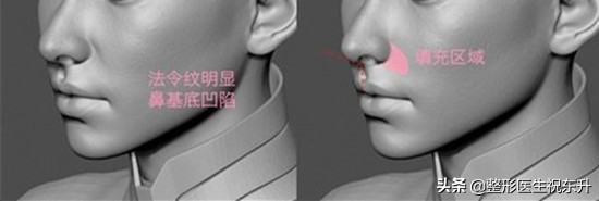 法令纹松弛脸颊下垂怎么填充,用什么来填充法令纹是最好的