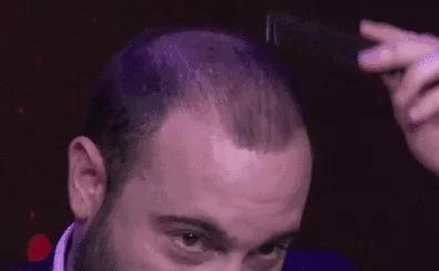 如果你没有头发你一定很秃,不管你的头顶有多秃