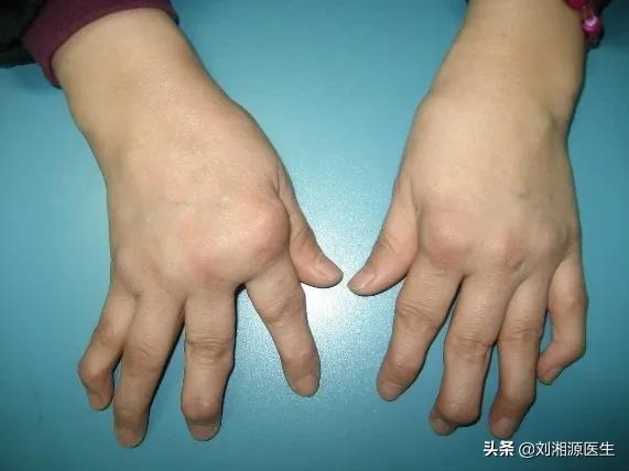 【免疫相关不良妊娠答疑解惑18】——类风湿关节炎（上）