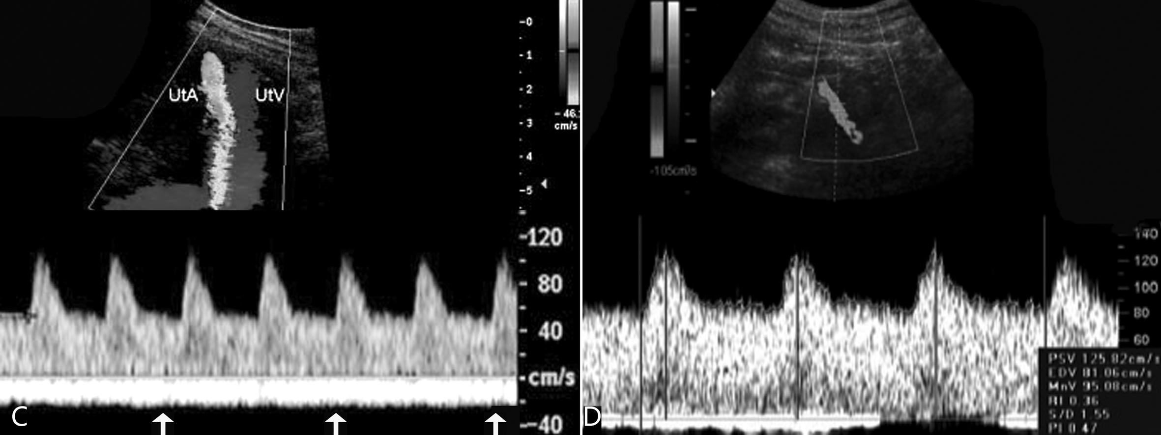 明明白白做超声23-2:妊娠期子宫及卵巢超声多普勒检查