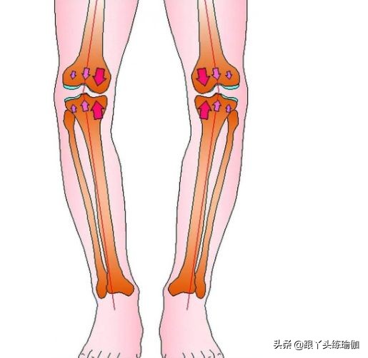 o型腿怎么矫正最有效的动作,o型腿快速矫正正确方法