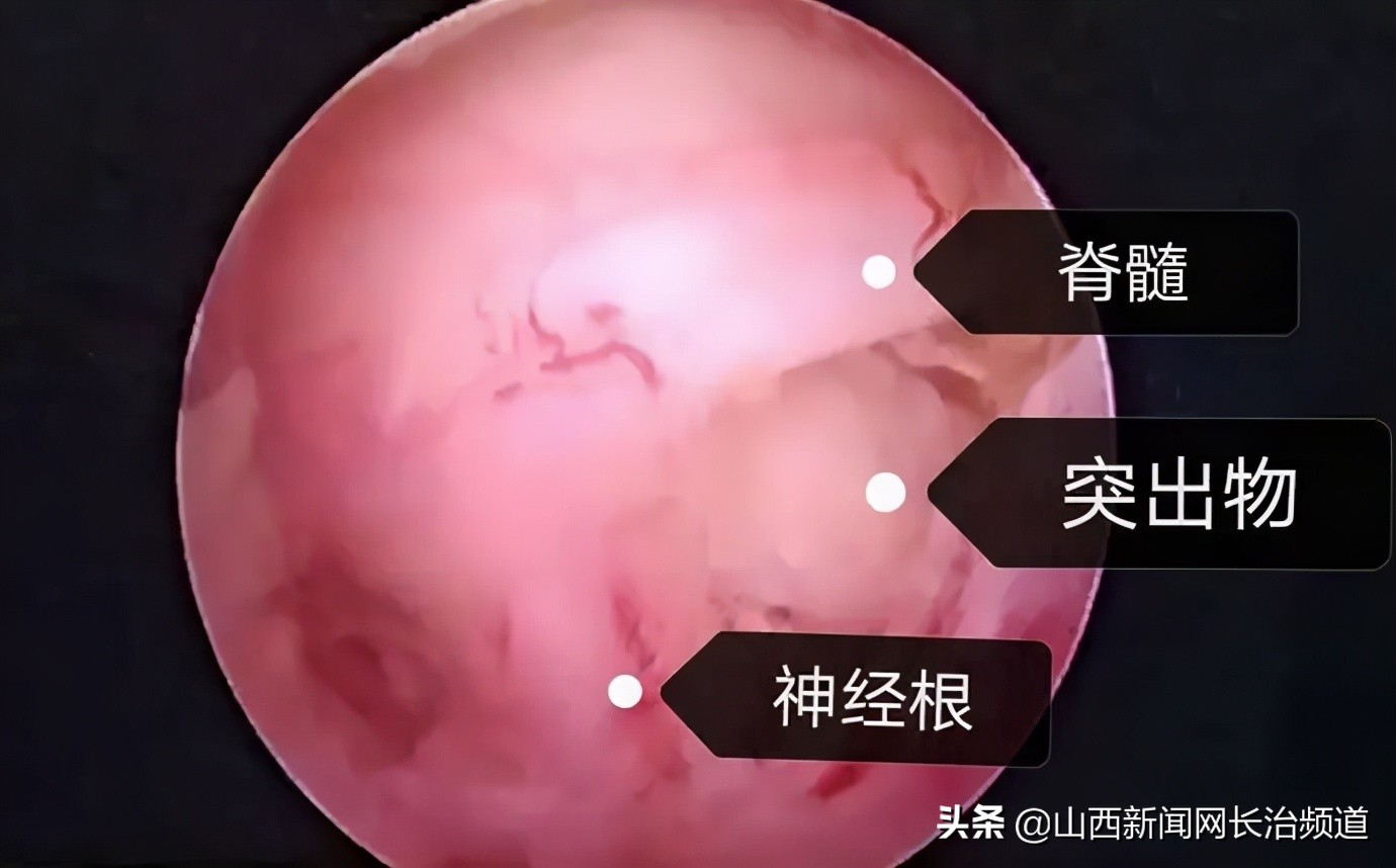 和平技术|疼起来要命的颈椎,一个“钥匙孔”搞定