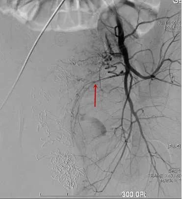 一产妇手术台上大出血死亡,一产妇大出血急需血小板去世