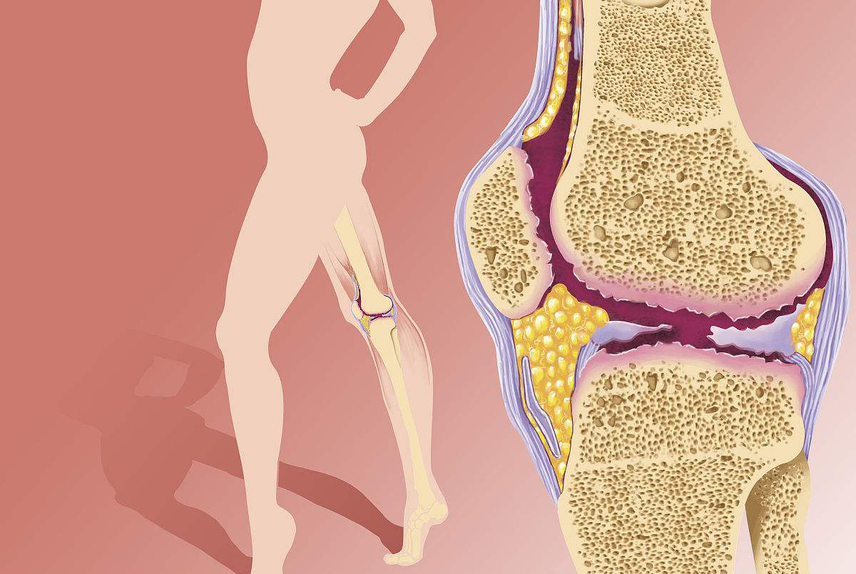 治疗骨关节炎消炎止痛的膏药,骨关节炎症怎么办才能彻底消除