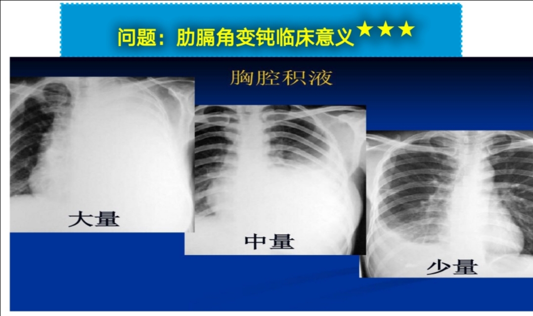 如何通过胸片判断胸腔积液量?