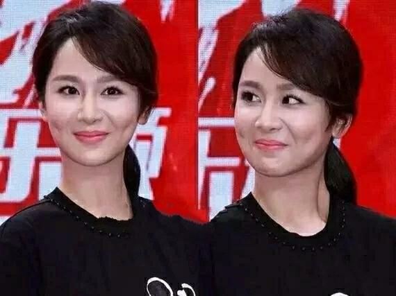 医美去除眼袋和法令纹的方法,医美脸部法令纹怎么消除