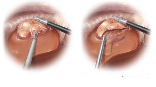 囊肿长哪地方,囊肿一般长在什么地方