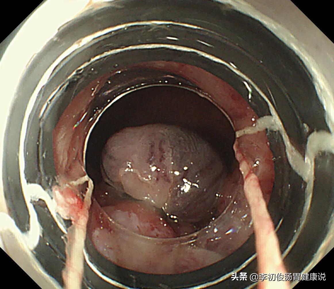 一次无痛胃肠镜一共需要多久,一次做完胃肠镜