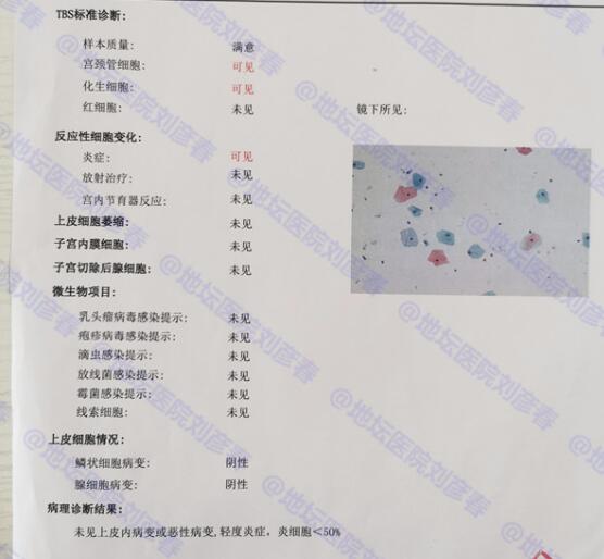 tct炎症反应性细胞改变需要治疗吗,tct显示中度炎症妇科怎么治疗