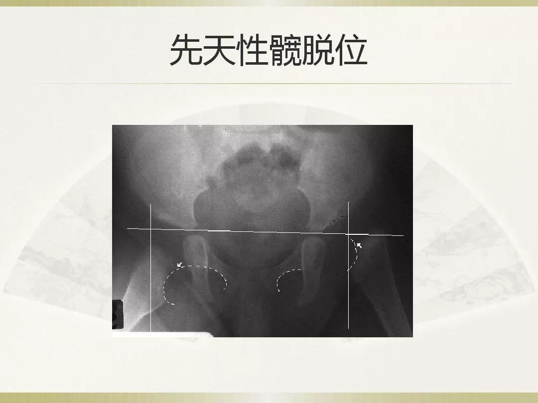 骨科x光片读片技巧,放射科骨科读片教程