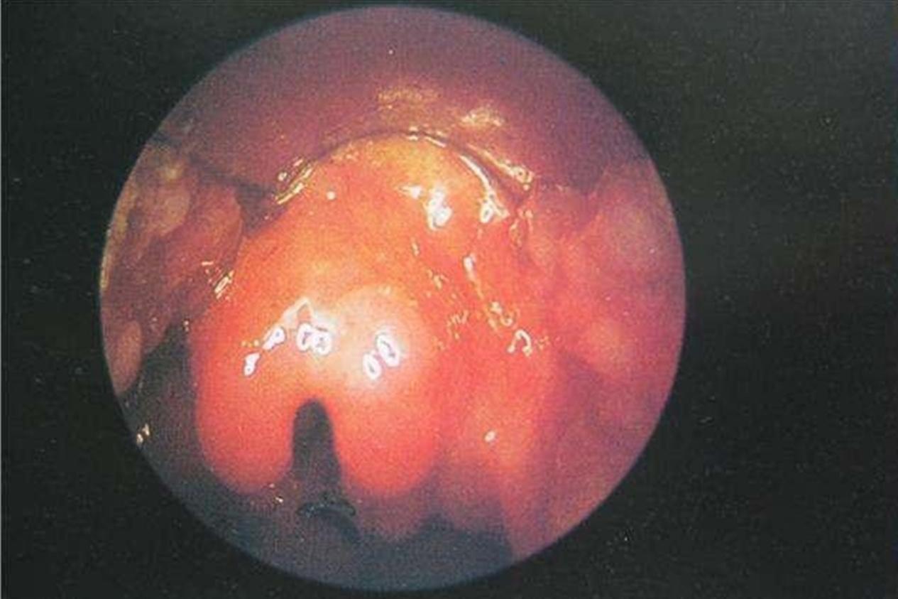 孩子犬吠似的咳嗽吃什么药,小孩咳嗽发出犬吠音怎么回事