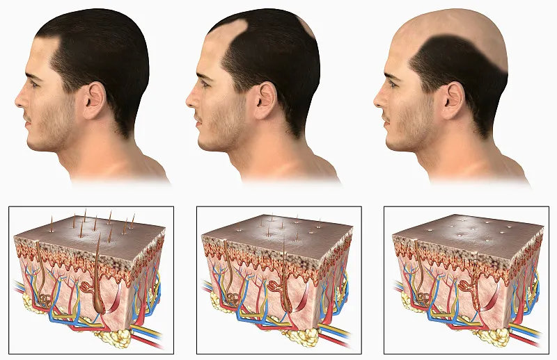 干细胞治疗秃头最新消息,干细胞治秃头