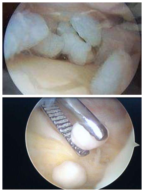 走路关节处咯咯响还痛是怎么回事,膝关节内有小老鼠怎么回事