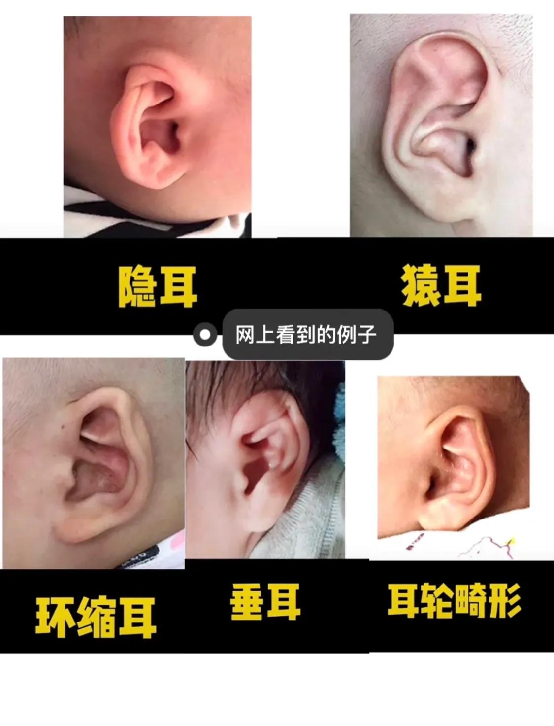宝宝刚出生耳廓畸形，现在长成什么样了？