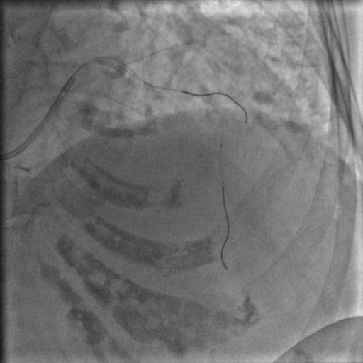 85岁老人心脏堵塞,77岁老人冠脉狭窄放支架还是搭桥