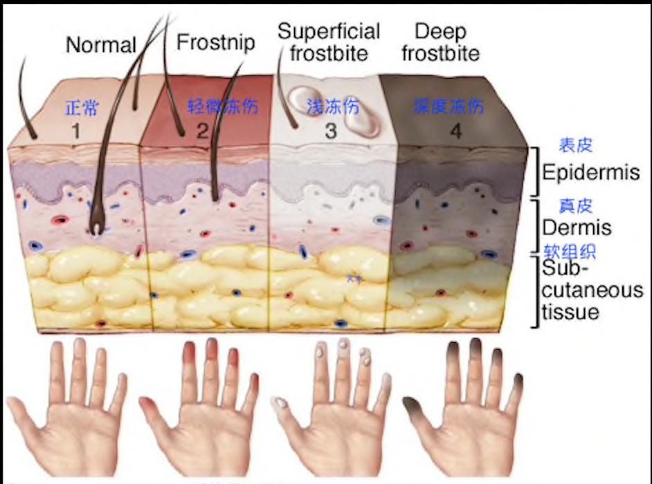 孩子被冻伤,小朋友在户外活动受伤了怎么解决