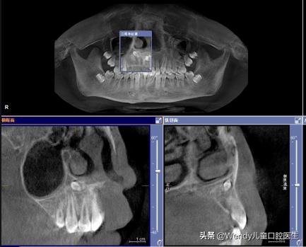 小孩乳牙掉了一直不长是什么原因,小孩乳牙掉了迟迟不出啥原因