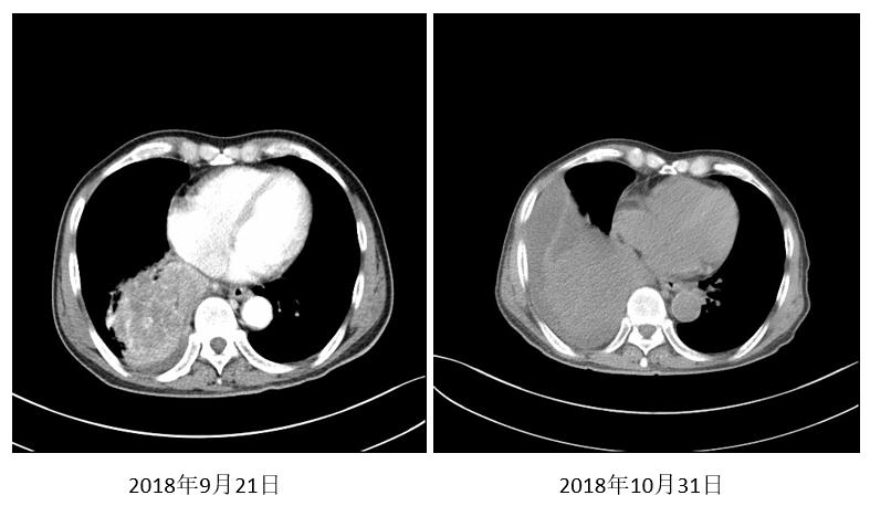 信迪利单抗治疗肺鳞癌效果,信迪利单抗治疗肺鳞癌晚期
