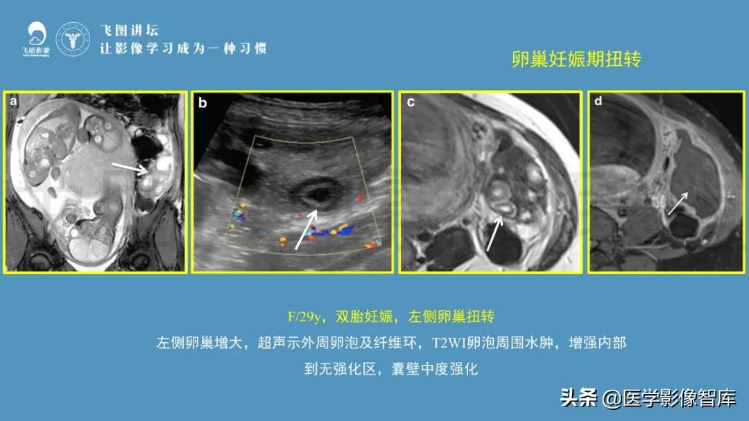 子宫解剖结构输卵管和卵巢位置,子宫附件ct影像学正常解剖表现